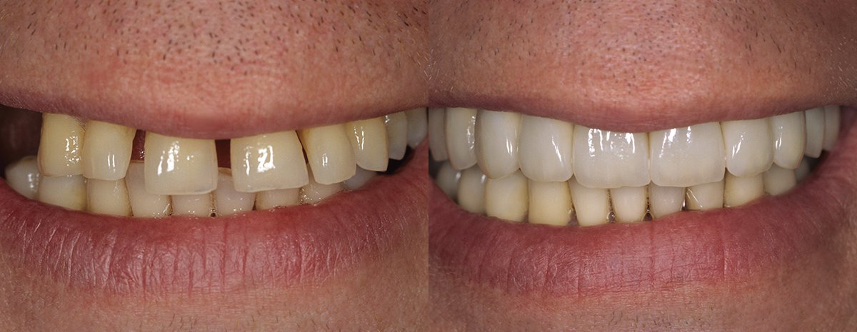 Implant Restorations
