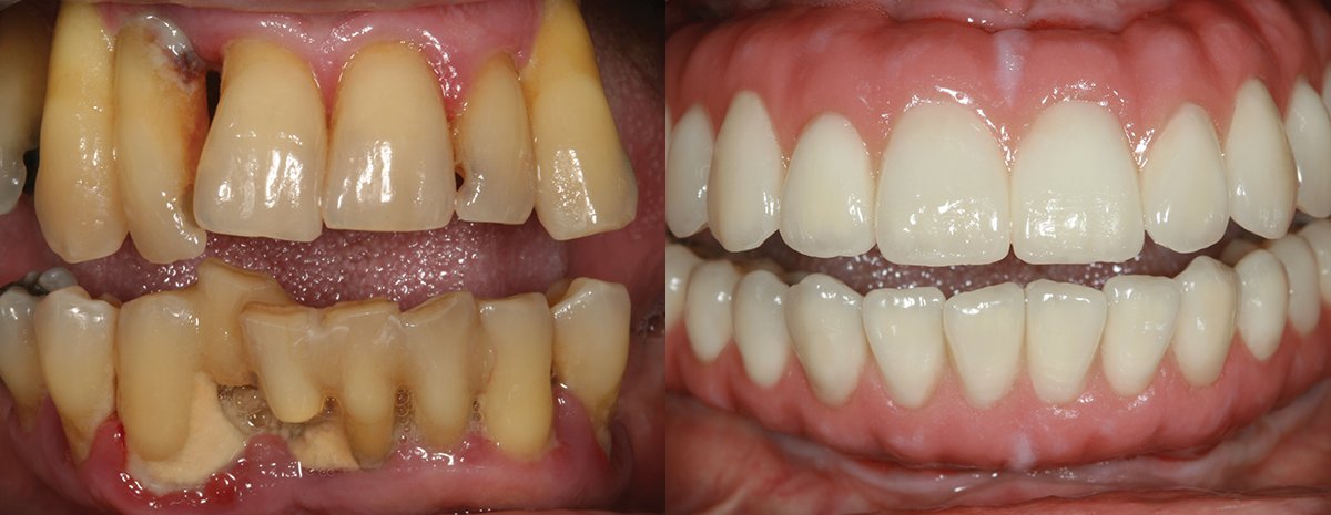 Implant